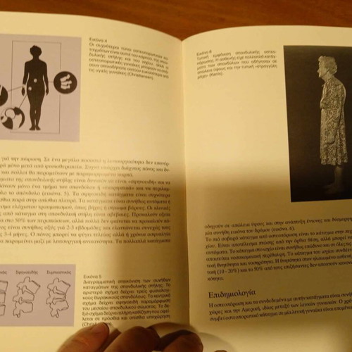 Postmenopausal Osteoporosis used book