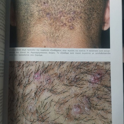 Dermatologic Diseases like new, diagnosis and treatment