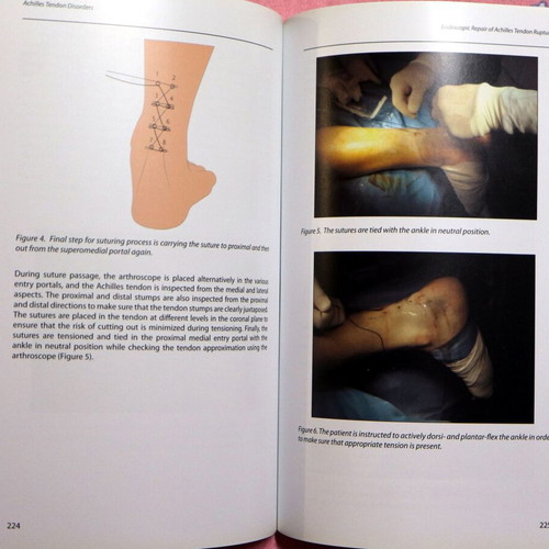 Achilles Tendon Disorders new, English medical textbook