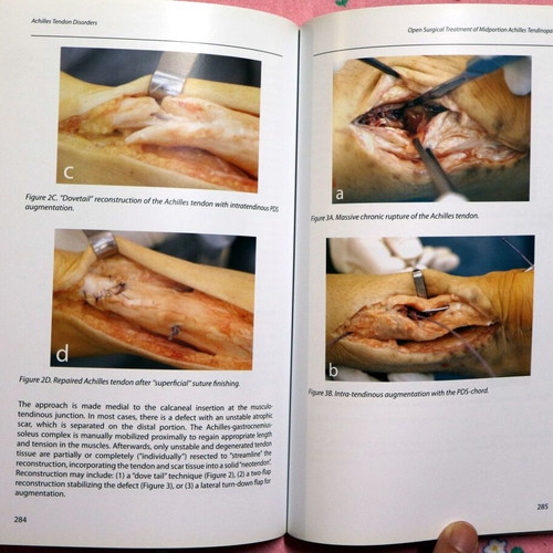 Achilles Tendon Disorders new, English medical textbook
