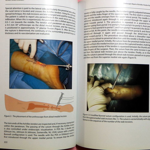 Achilles Tendon Disorders new, English medical textbook