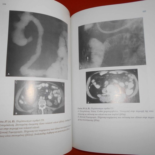 PhD thesis used, Radiological study of small intestine, 135 pages