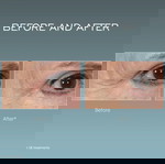  Iluminage Youth Activator Anti-Aging Device