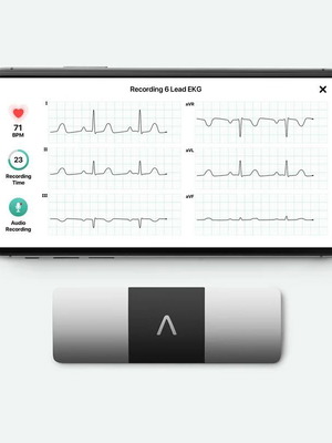 AliveCor KardiaMobile 6L φορητή συσκευή ΗΚΓ 6 απαγωγών για smartphone